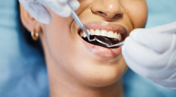 Emergency Dental Filling Replacement in LA